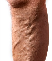 veneous insufficiency, lower limb